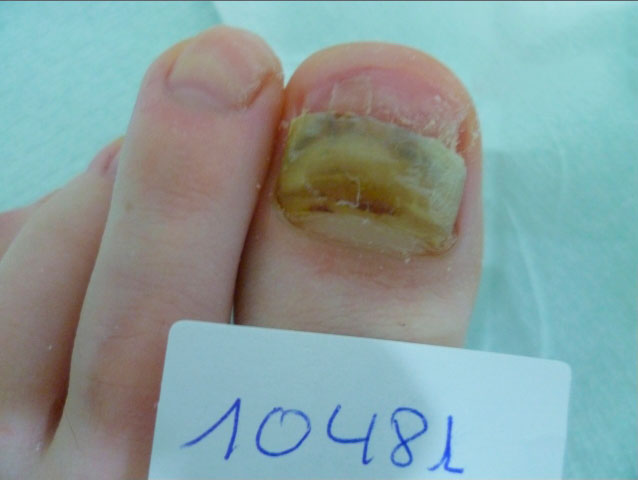 omnicomicosis-1 onicomicosis hongos en las uñas