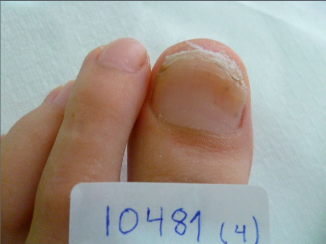 omnicomicosis-2 resultado tratamiento onicomicosis hongos en las uñas