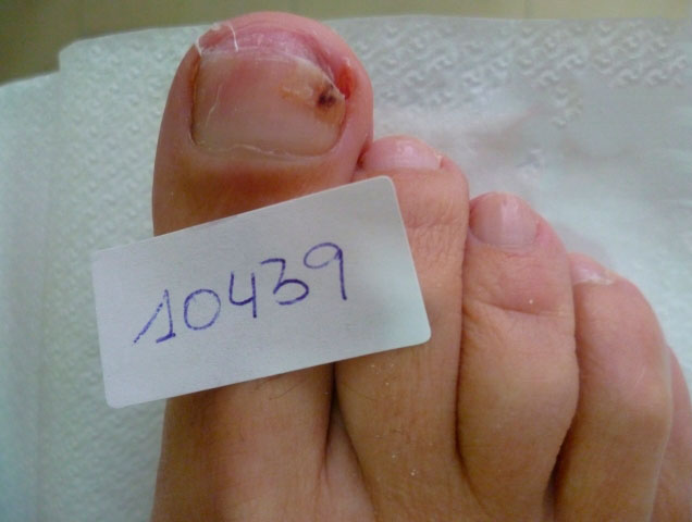 omnicomicosis-laser-pinpointe-1 onicomicosis hongos en las uñas