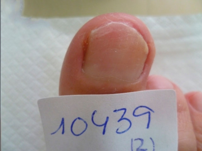 omnicomicosis-laser-pinpointe-2 resultado tratamiento onicomicosis hongos en las uñas