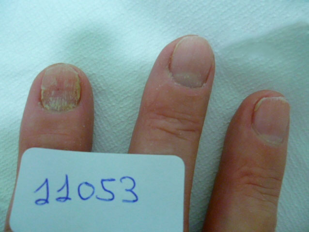 omnicomicosis-manos-laser-lunula-1 onicomicosis hongos en las uñas