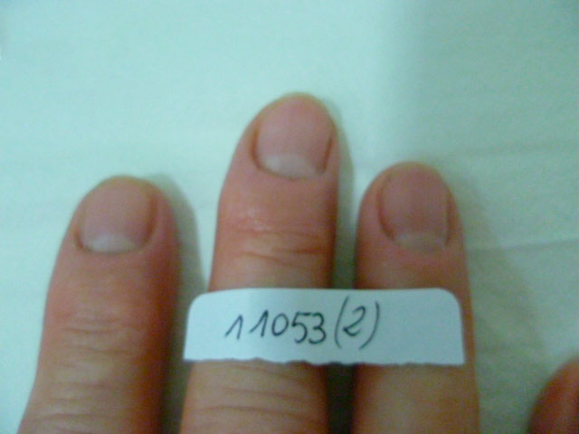 omnicomicosis-manos-laser-lunula-2 resultado tratamiento onicomicosis hongos en las uñas