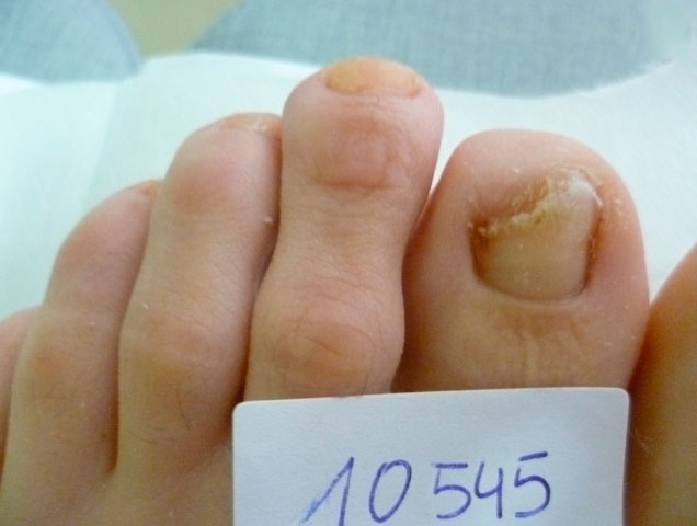 omnicomicosis-pie-laser-lunula-1 onicomicosis hongos en las uñas