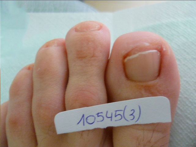 omnicomicosis-pie-laser-lunula-2 resultado tratamiento onicomicosis hongos en las uñas