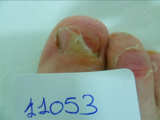 omnicomicosis-pies-laser-lunula-1 onicomicosis hongos en las uñas