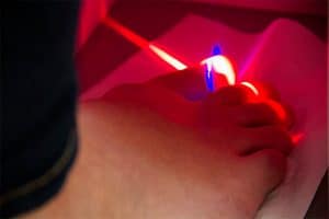 laser solucionar hongos en las uñas