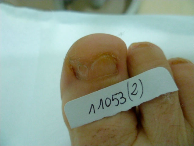 resultado tratamiento onicomicosis hongos en las uñas